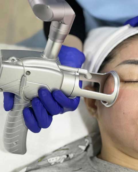Fractional CO2 Laser Treatment at HealMe